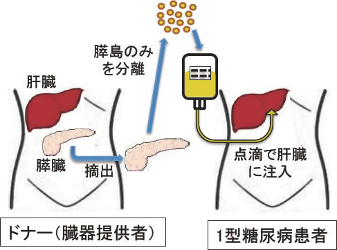 他者からの移植