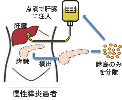 膵島移植の方法